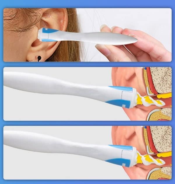 אישה משתמשת במכשיר לניקוי אוזניים כדי לנקות את האוזן שלה.